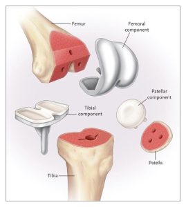 Total Knee Replacement