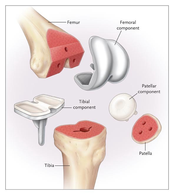 Total Knee Replacement