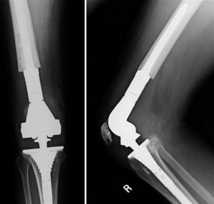 Total Knee Replacement